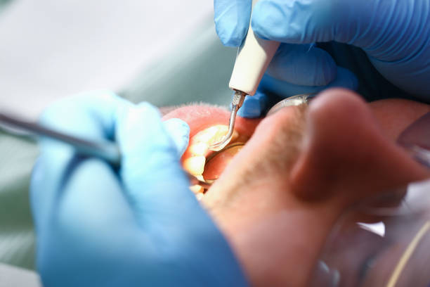Best Emergency Tooth Extraction in Rancho Mission Viejo, CA
