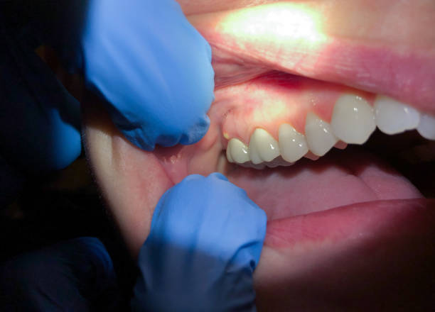 Best Emergency Treatment for Dental Infections or Abscesses in Rancho Mission Viejo, CA